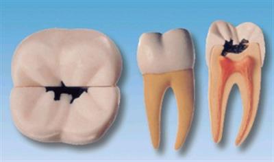 右侧一颗磨牙蛀牙模型HK-L1002
