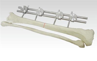 外固定器(组合式)281000